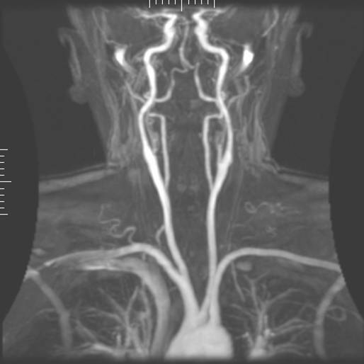 Educational magnetic resonance angiography image showing the major neck arteries from the front