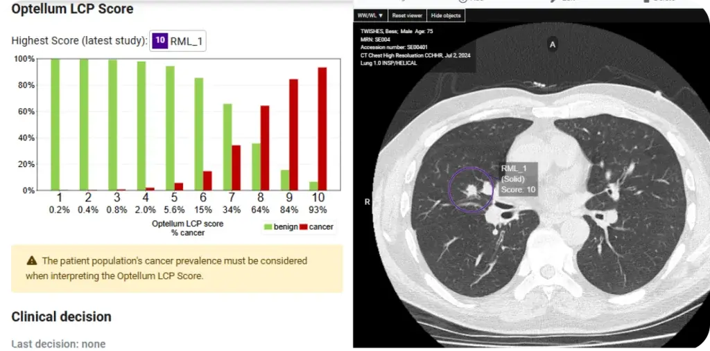 Optellum manufacturer demonstration showing CT views, a marked pulmonary nodule and AI risk analysis